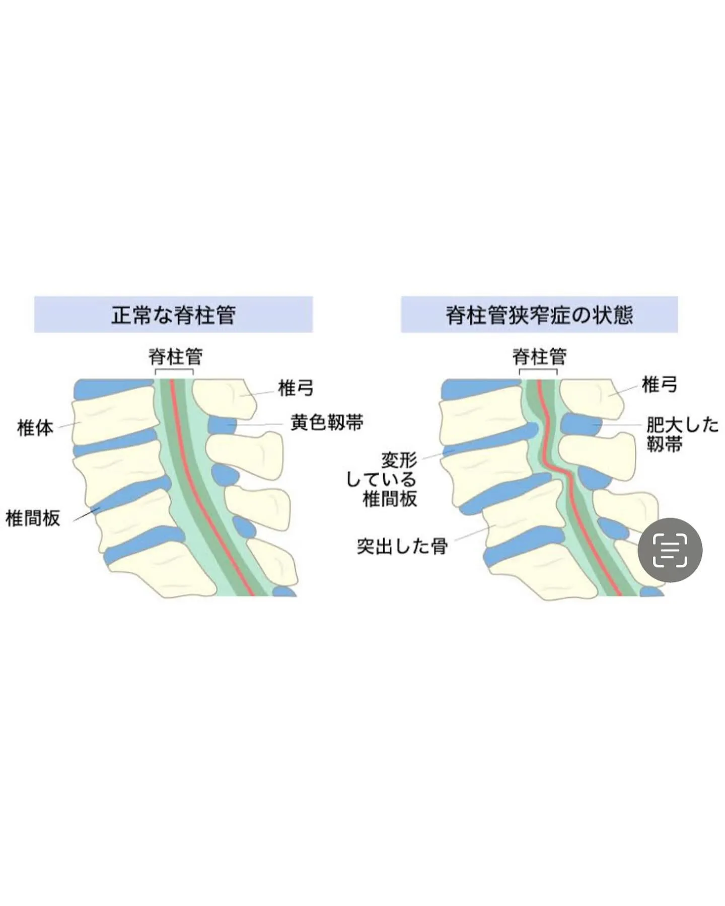 『腰痛』で悩んでいる方へなき😓